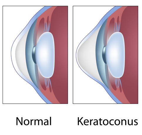 How Does Corneal Cross Linking Treat Keratoconus Dell Laser Consultants